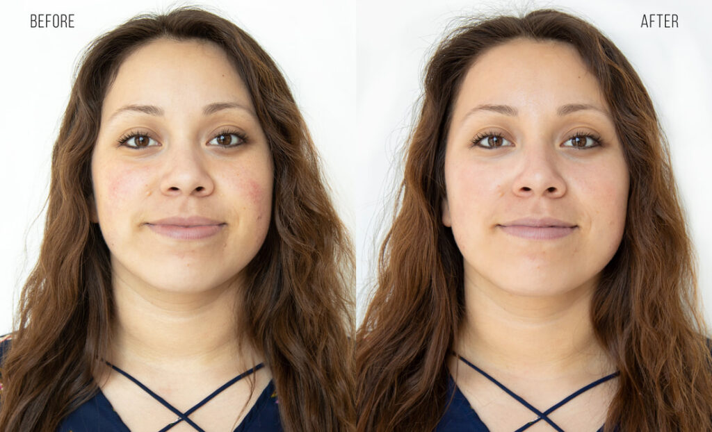 Clogged Pores Skin Care